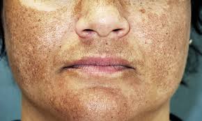 Melasma Dérmico